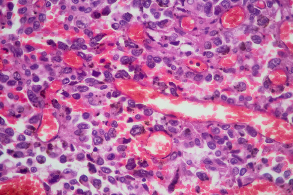 Mesothelioma 101: Non-Small Cell Lung Cancer Vs. Mesothelioma