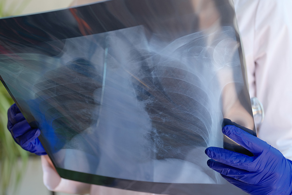 Global Mesothelioma Cases Surge as Asbestos Use Continues